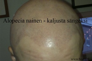 Alopecia nainen 11.2013